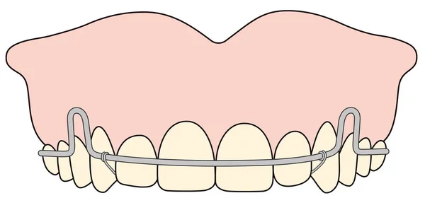 L'apparecchio ortodontico rimovibile viene utilizzato dopo il trattamento ortodontico per la ritenzione — Foto Stock