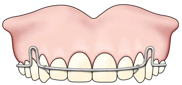 L'apparecchio ortodontico rimovibile viene utilizzato dopo il trattamento ortodontico per la ritenzione — Foto Stock