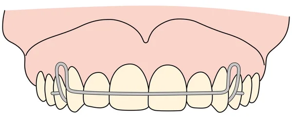 Removable orthodontic appliance is used after orthodontic treatment for retention — 스톡 사진