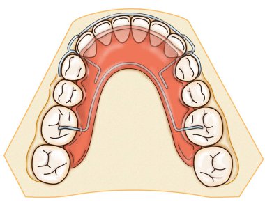 Removable orthodontic appliance is used after orthodontic treatment for retention clipart