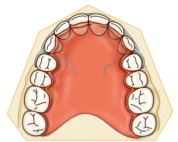 Appareil orthodontique amovible est utilisé après traitement orthodontique pour la rétention — Photo