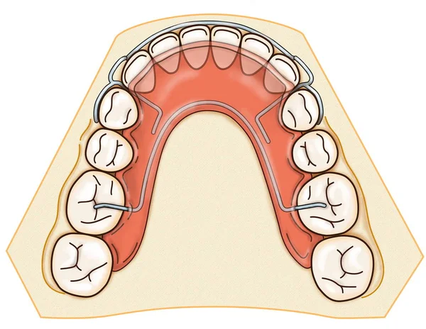 Съемный ортодонтический прибор используется после ортодонтического лечения для сохранения — стоковое фото