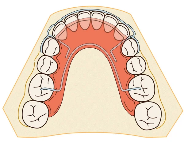Съемный ортодонтический прибор используется после ортодонтического лечения для сохранения — стоковое фото
