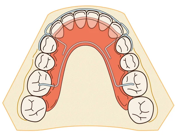 Appareil orthodontique amovible est utilisé après traitement orthodontique pour la rétention — Photo