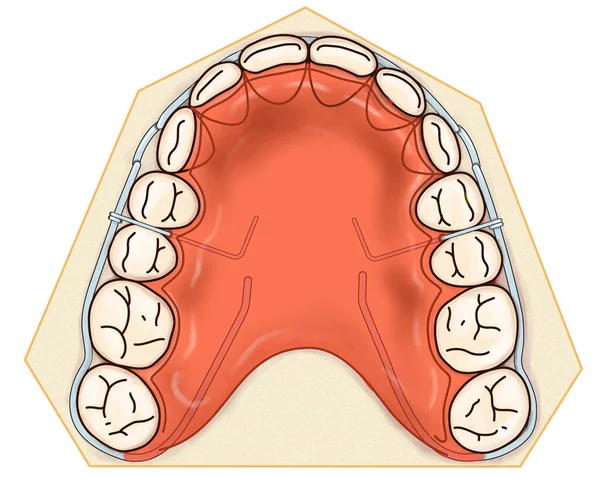 Appareil orthodontique amovible est utilisé après traitement orthodontique pour la rétention — Photo