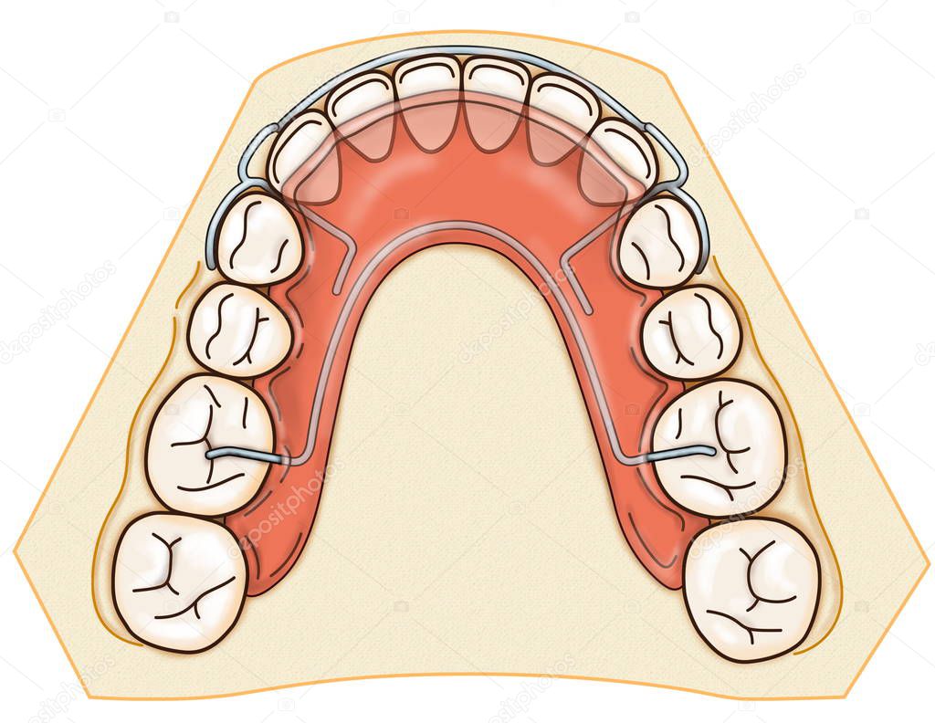 Removable orthodontic appliance is used after orthodontic treatment for retention