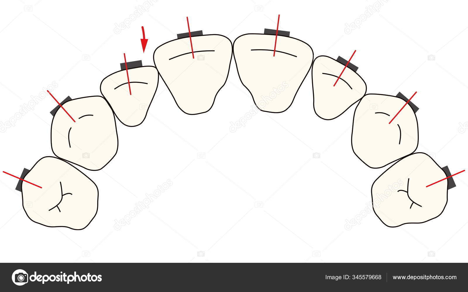 Removable orthodontic appliance is used after orthodontic treatment for