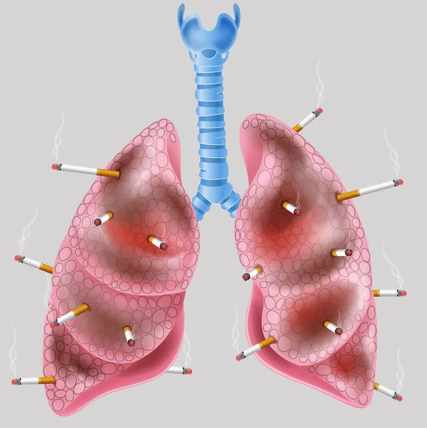 Cigarette sur le poumon — Image vectorielle