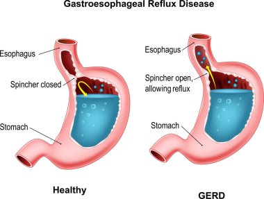 Gastroesophageal reflux disease clipart