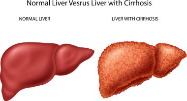 Normal liver versus liver with Cirrhosis clipart