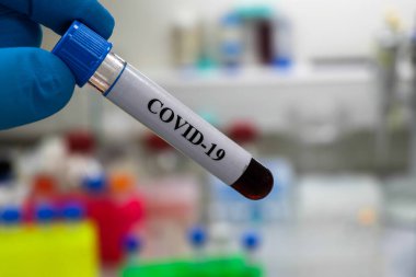 COVID-19 için kan testi. SARS-CoV-2 koronavirüsünün varlığı için kan örneği inceleniyor..