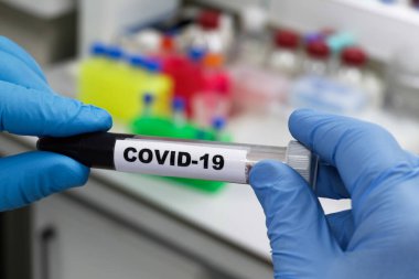COVID-19 için kan testi. SARS-CoV-2 koronavirüsünün varlığı için kan örneği inceleniyor..