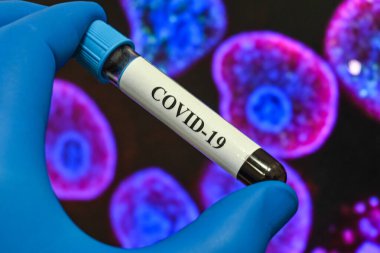 Covid-19 'a sebep olan koronavirüs için kan testi. Sars-Cov-2 testi için bir kan örneği..