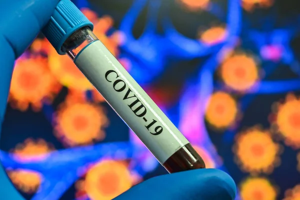 Análisis Sangre Para Coronavirus Que Causa Covid Una Muestra Sangre —  Fotos de Stock