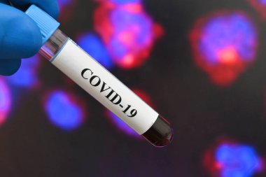 Koronavirüsün tespiti, COVID-19 hastalığının patojeni. SARS-CoV-2 testi için kan testi tüpü..