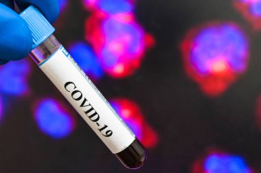 Coronavirus testi. COVID-19 teşhisi için numune içeren test tüpü.