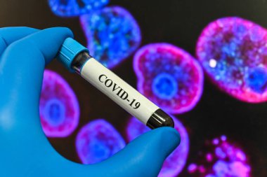 Coronavirus testi. COVID-19 teşhisi için numune içeren test tüpü.