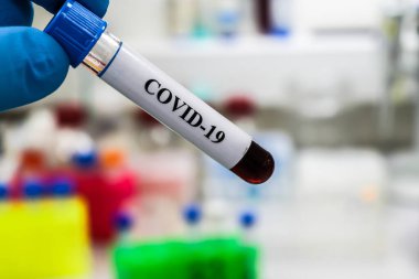 Coronavirus testi. COVID-19 teşhisi için numune içeren test tüpü.