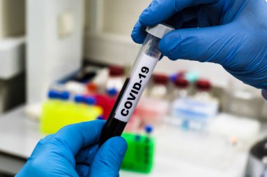 Coronavirus testi. COVID-19 teşhisi için numune içeren test tüpü.