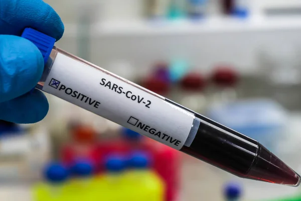 Prueba Del Coronavirus Tubo Ensayo Con Muestra Para Diagnóstico Covid —  Fotos de Stock