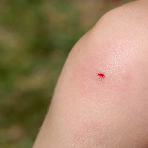 Sangre en la rodilla — Foto de Stock