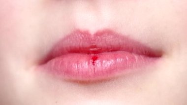 Bir çocuğun çatlak dudaklarında kan var.