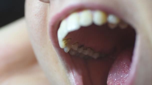 Zahnbelag Makroschuss Bei Erwachsener Frau Schwarze Ablagerungen Auf Den Zähnen — Stockvideo