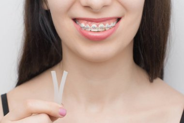 Diş tellerine ortodoentik ağda uyguluyorum. Dişleri beyazladıktan sonra diş telleri takılmış. Metal kravatlı, gri lastikli ya da mükemmel bir gülümseme için lastik bantlı kendi kendine bağlanan parantezler. Ortodontik diş tedavisi