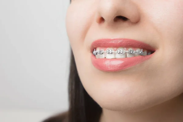 Jovem Sorri Com Aparelho Dentário Suportes Nos Dentes Após Clareamento — Fotografia de Stock