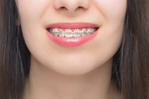 Mujer Joven Sonrisa Con Frenos Dentales Soportes Los Dientes Después — Foto de Stock