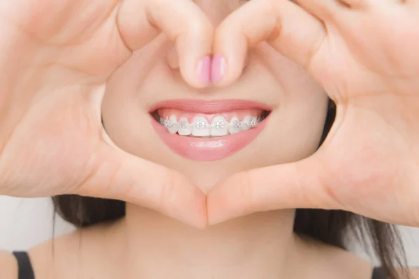 Szelki Dentystyczne Ustach Szczęśliwych Kobiet Przez Serce Wsporniki Zębach Wybieleniu — Zdjęcie stockowe