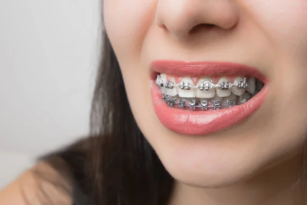 Young Woman Smile Dental Braces Brackets Teeth Whitening Self Ligating — Stock Photo, Image