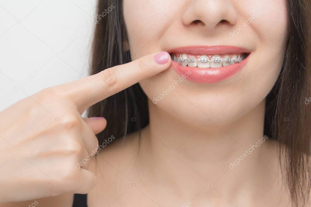 Dental braces in happy womans mouths who shows by finger on brackets on the teeth after whitening. Self-ligating brackets with metal ties and gray elastics or rubber bands for perfect smile. Orthodontic teeth treatment