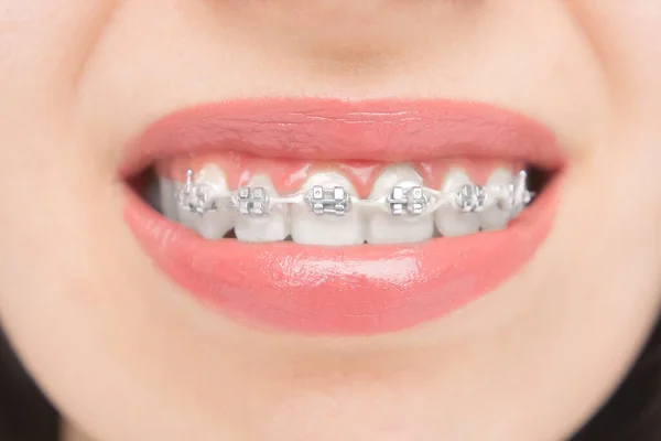 接近牙齿的支撑 美白后牙齿上的支架 带有金属领带和灰色弹性体或橡皮筋的自联括号 牙齿矫正治疗 — 图库照片