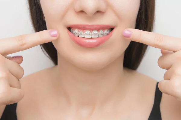 白くなってから歯のブラケットに2本の指で示す幸せな女性の口の中で歯科矯正 金属製のネクタイとグレーの弾性または完璧な笑顔のためのゴムバンドを持つ自己照明ブラケット 歯の矯正治療 — ストック写真