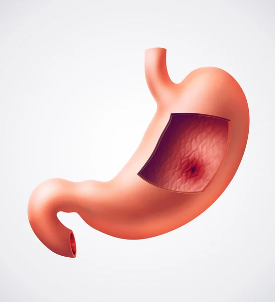 Problema de úlcera de estómago — Foto de Stock