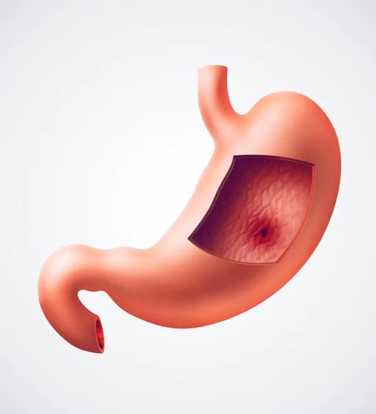 Stomach ulcer problem — ストック写真