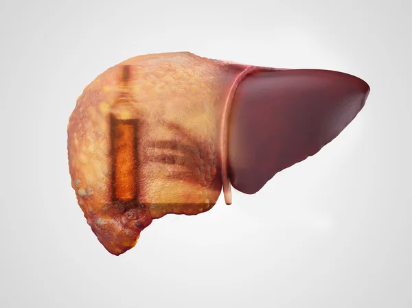 Liver and alcohol addiction double exposure — Stock Photo, Image