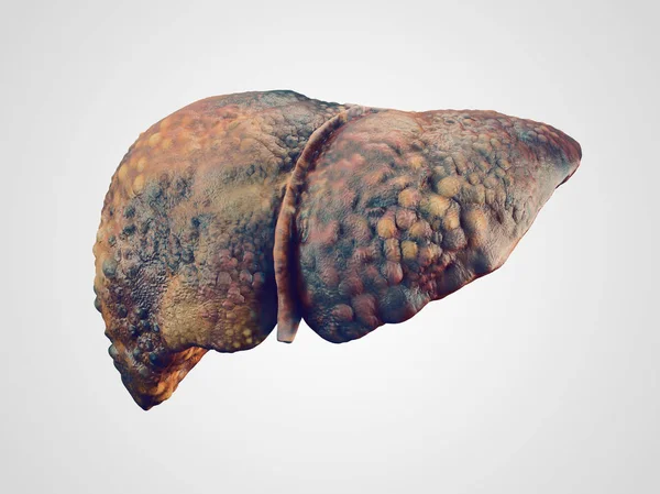 Realistic illustration of cirrhosis of human liver — Stock Photo, Image