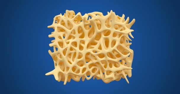 Animación osteoporosis ósea — Vídeo de stock