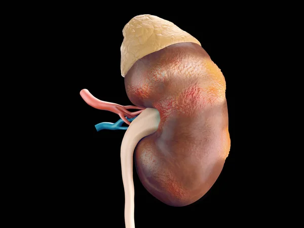 Cáncer renal humano — Foto de Stock