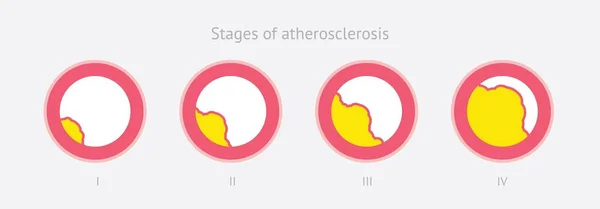 Estágios de aterosclerose em artéria —  Vetores de Stock