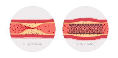 Hasta insan atardamarı lekeleniyor.