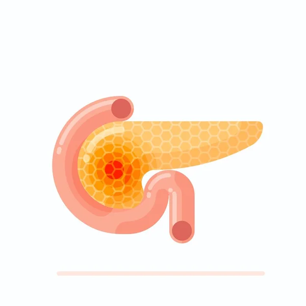 Pancreas umano malato — Vettoriale Stock