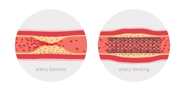 Stent arteria humana enferma — Vector de stock