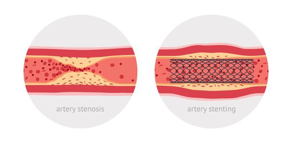Стентирование больной человеческой артерии
