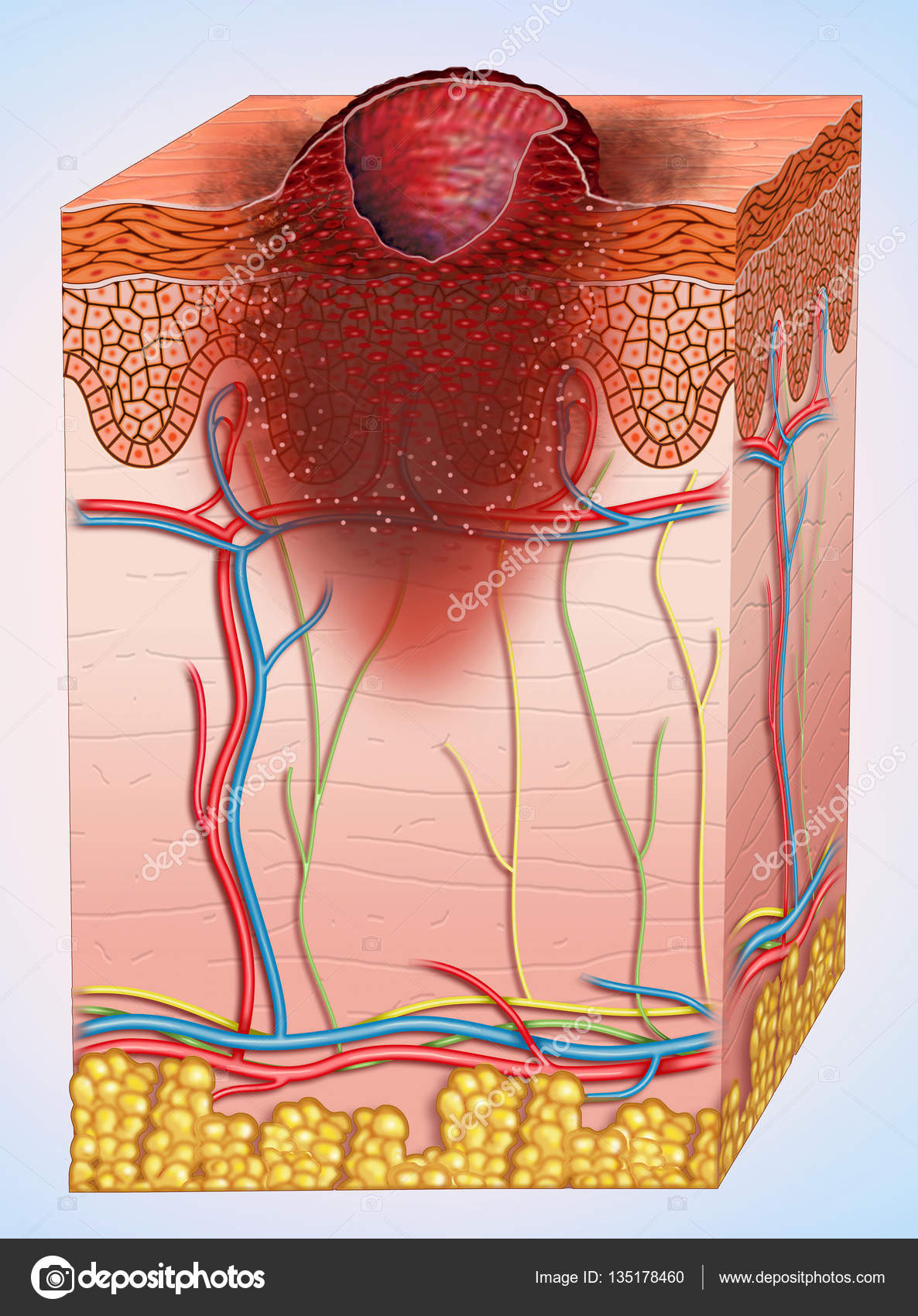 Ulcerated melanoma scheme — Stock Photo © Alexilus 135178460