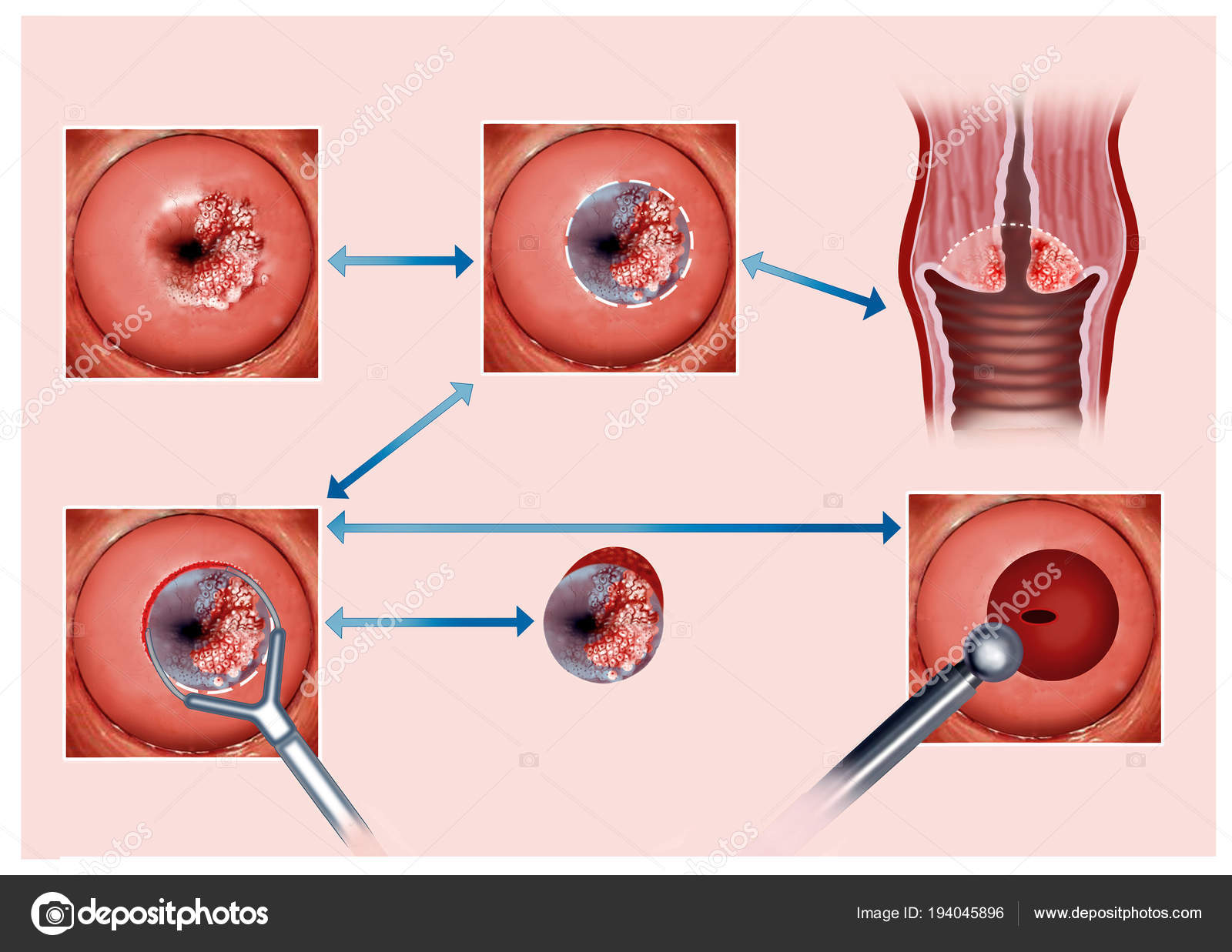 cauterizacion del cuello uterino