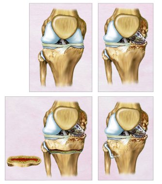 Descriptive illustration an Osteotomy or correction of the knee where the femur and tibia appear crooked. The surgical intervention is performed by traumatologists to re-align the knee. clipart