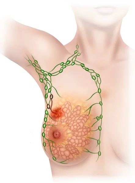 Rak piersi wykryty w układzie limfatycznym — Zdjęcie stockowe